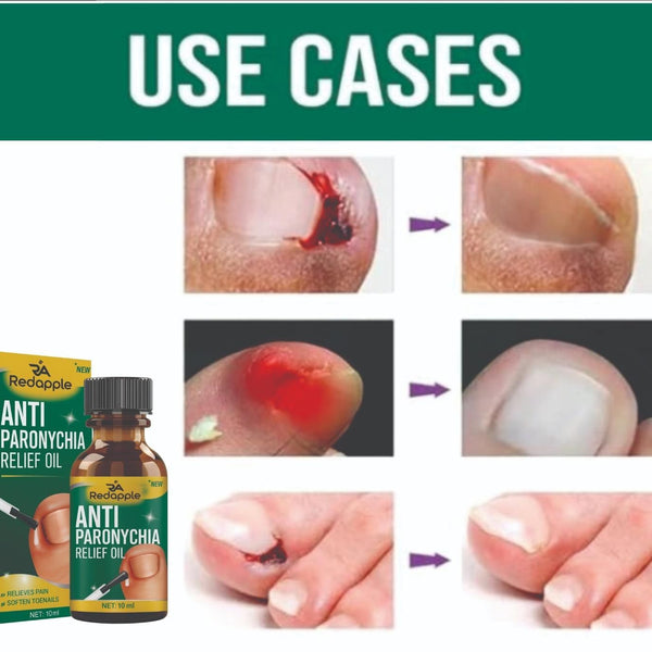 Anti Paronychia Relief Oil 10 ml Pack of 1