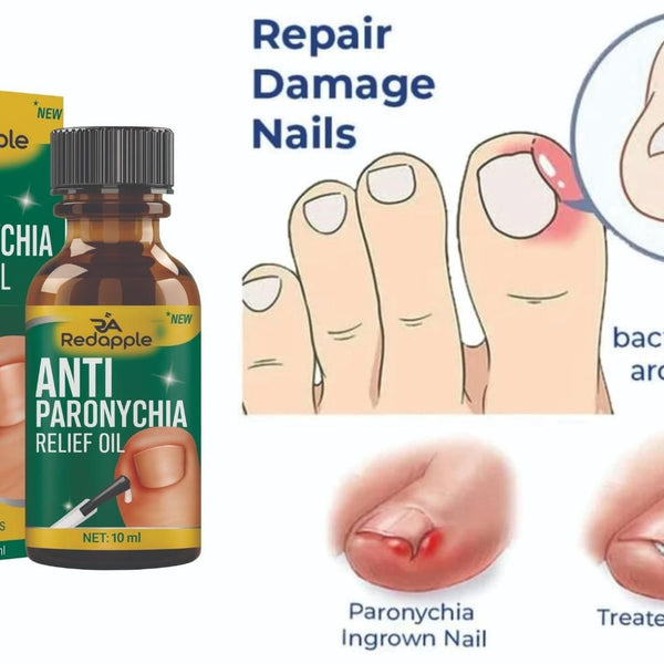 Anti Paronychia Relief Oil 10 ml Pack of 1
